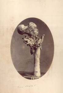 Left femur of a Confederate soldier, showing significant damage due to a gunshot wound at Gettysburg.
